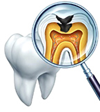 重度虫歯の抜歯回避