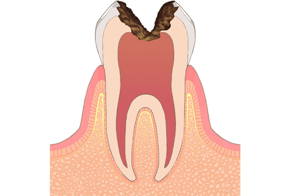 神経(歯髄)まで進行した虫歯